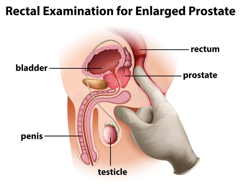 Simptomat që paralajmërojnë për zmadhim të prostatës